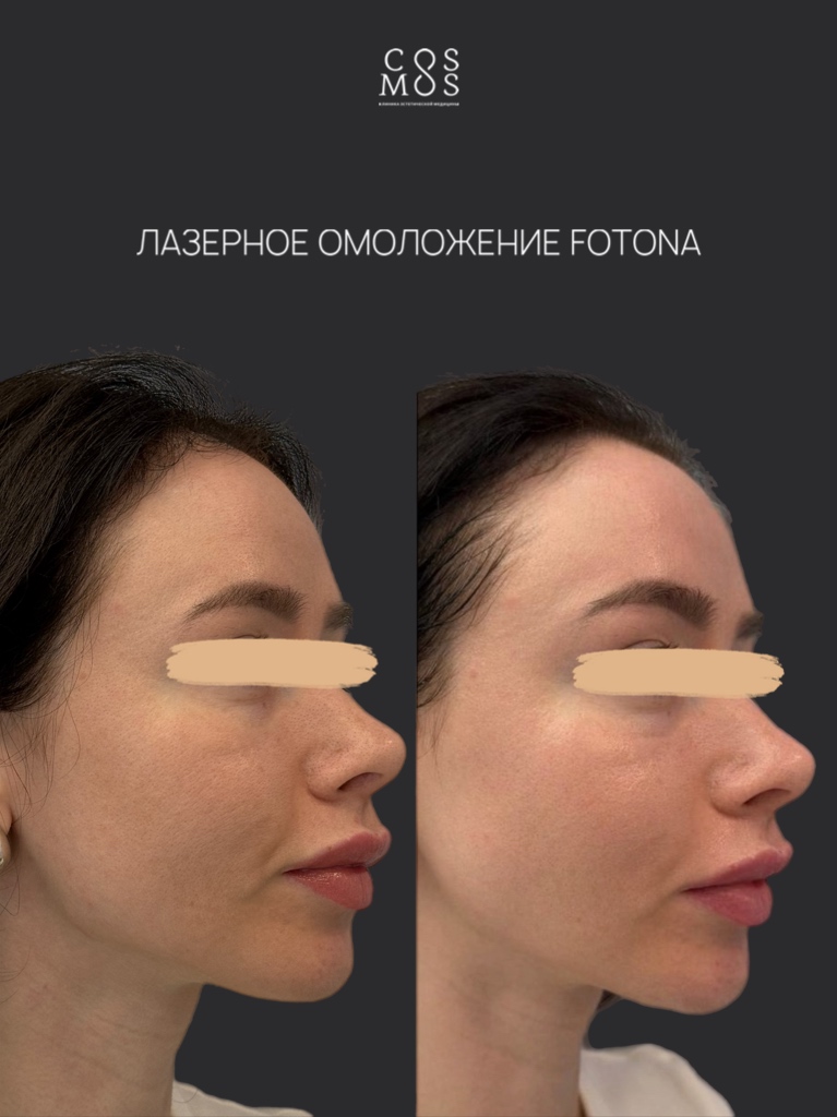 Лазерное омоложение Fotona