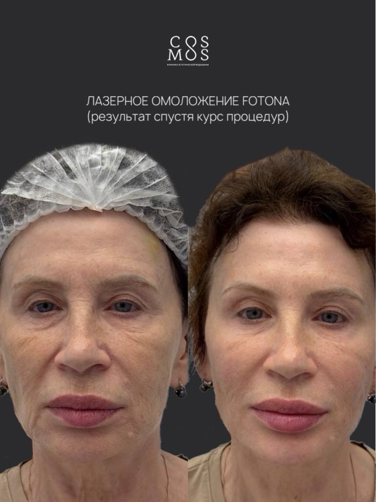 Лазерное омоложение Fotona