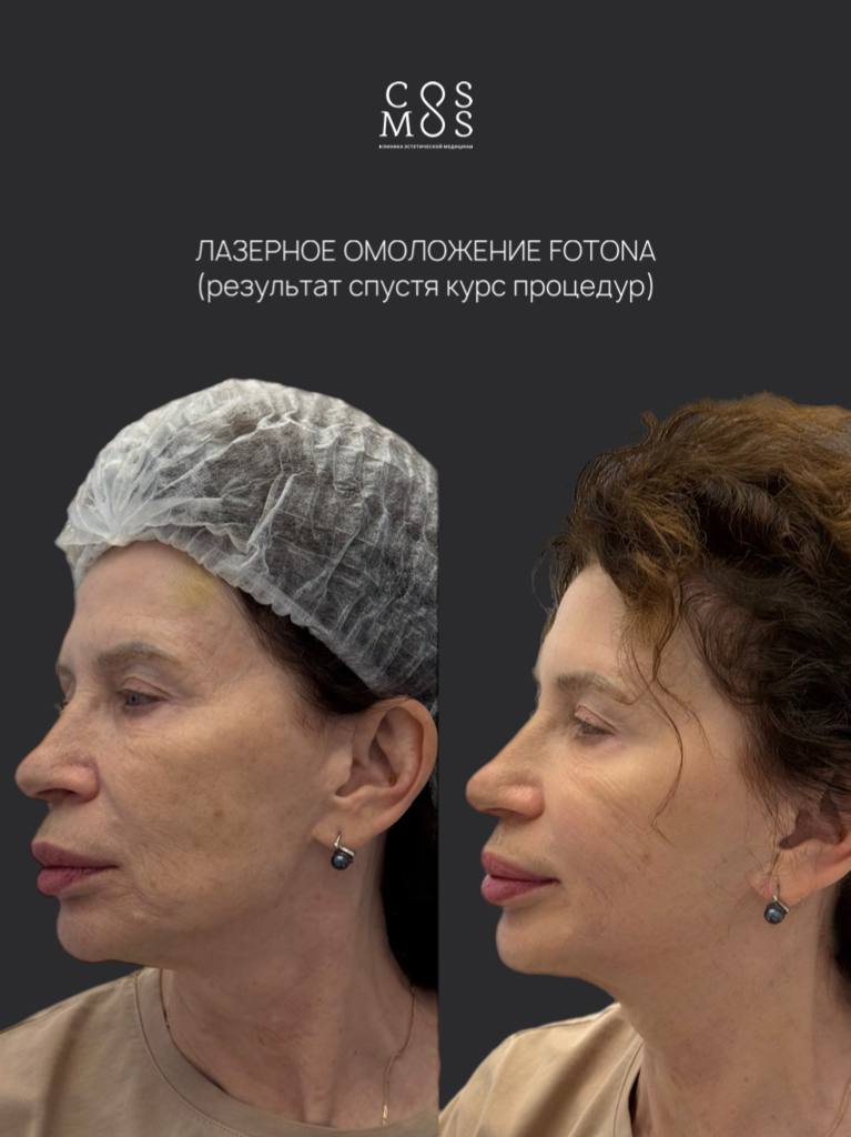 Лазерное омоложение Fotona
