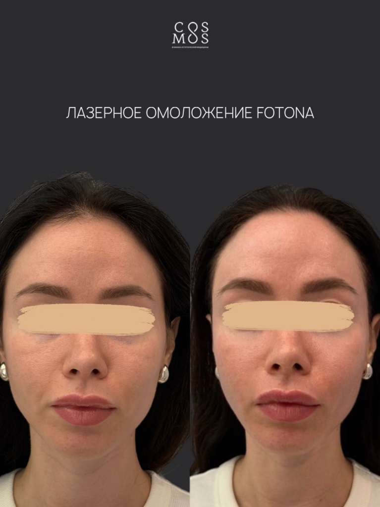 Лазерное омоложение Fotona