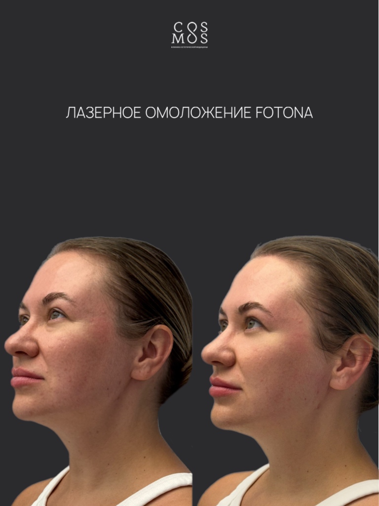 Лазерное омоложение Fotona