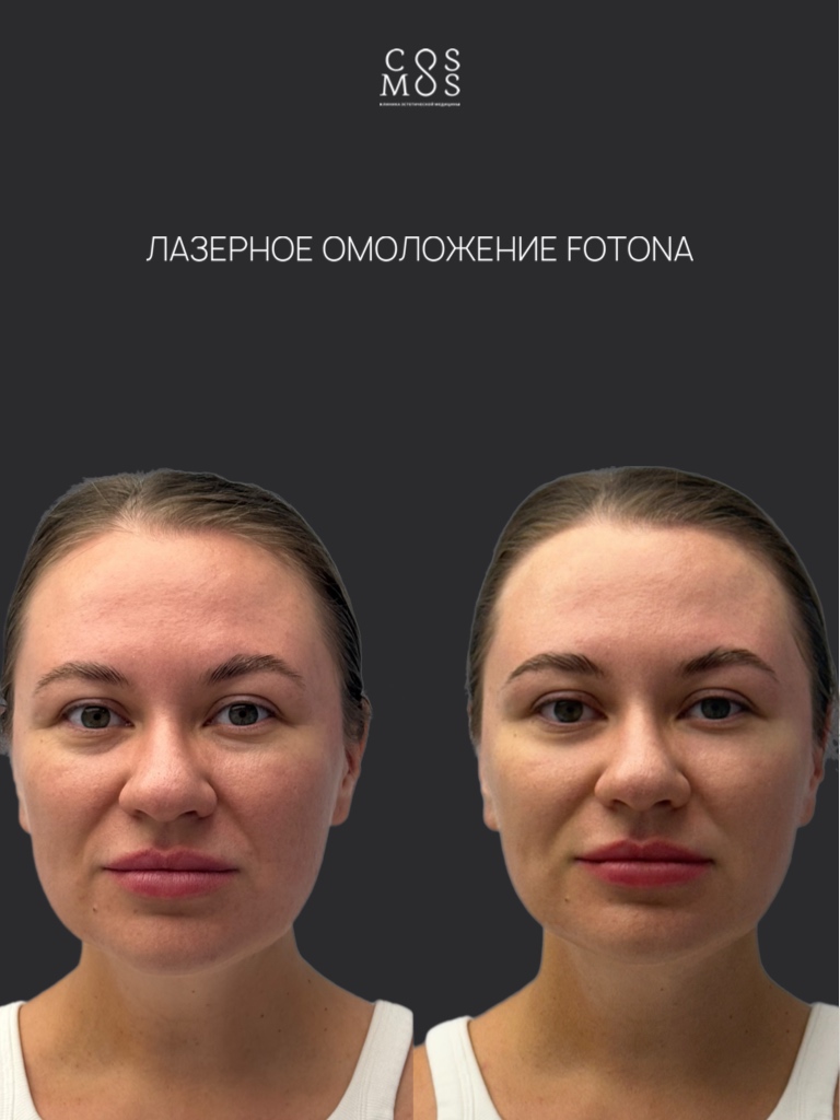 Лазерное омоложение Fotona