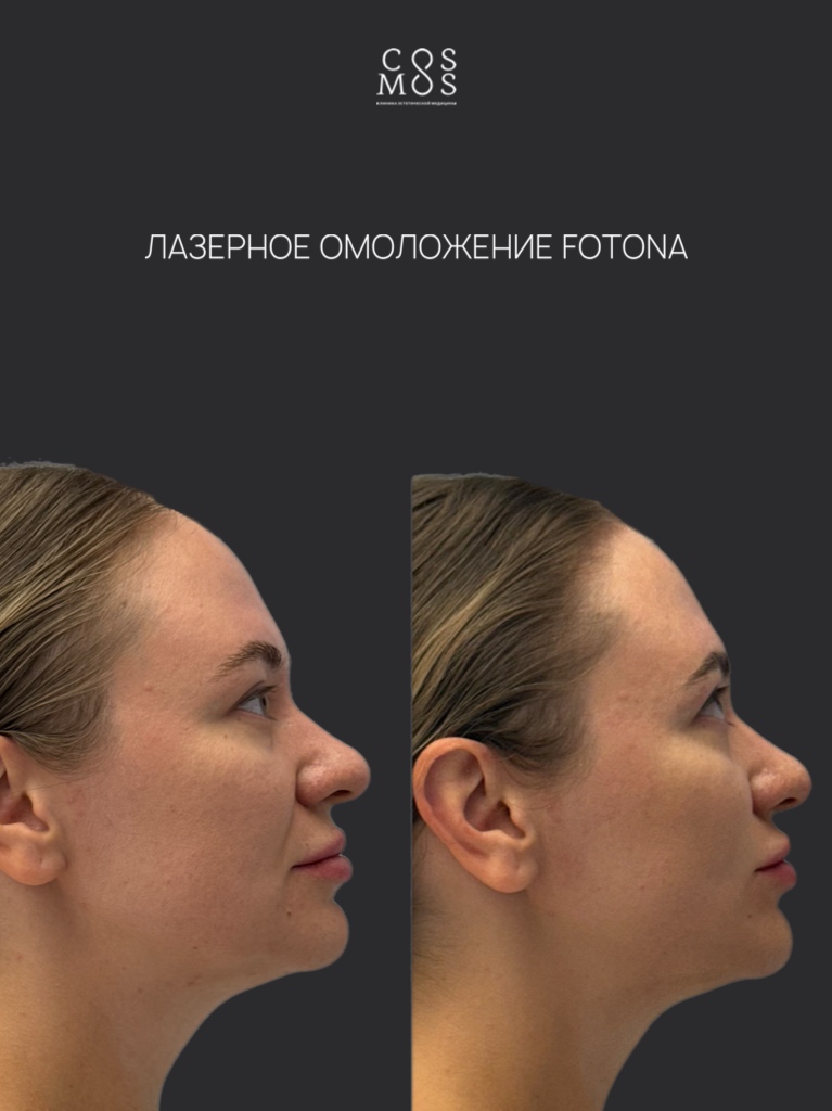 Лазерное омоложение Fotona