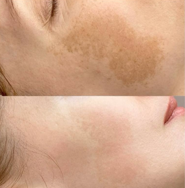 Фотодинамическая терапия Heleo4