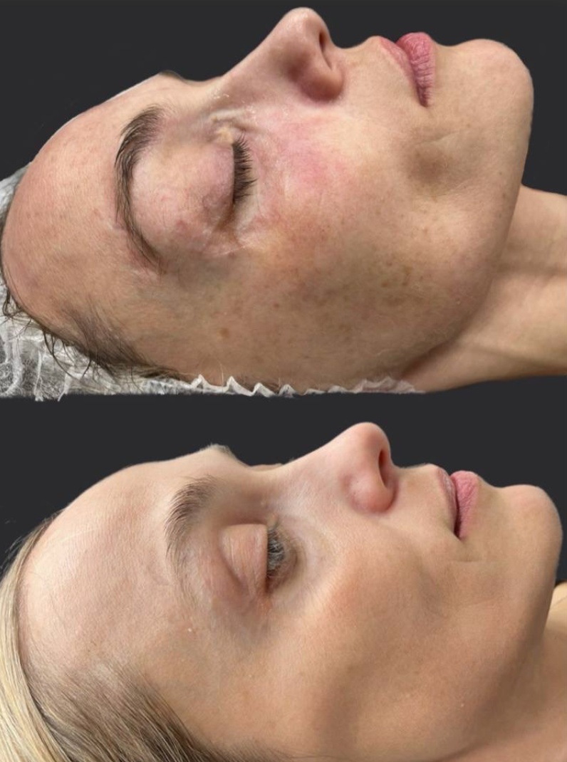 Фотодинамическая терапия Heleo4