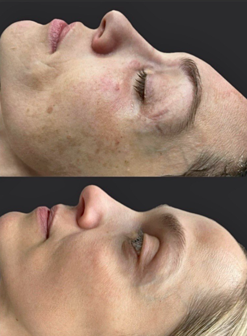 Фотодинамическая терапия Heleo4