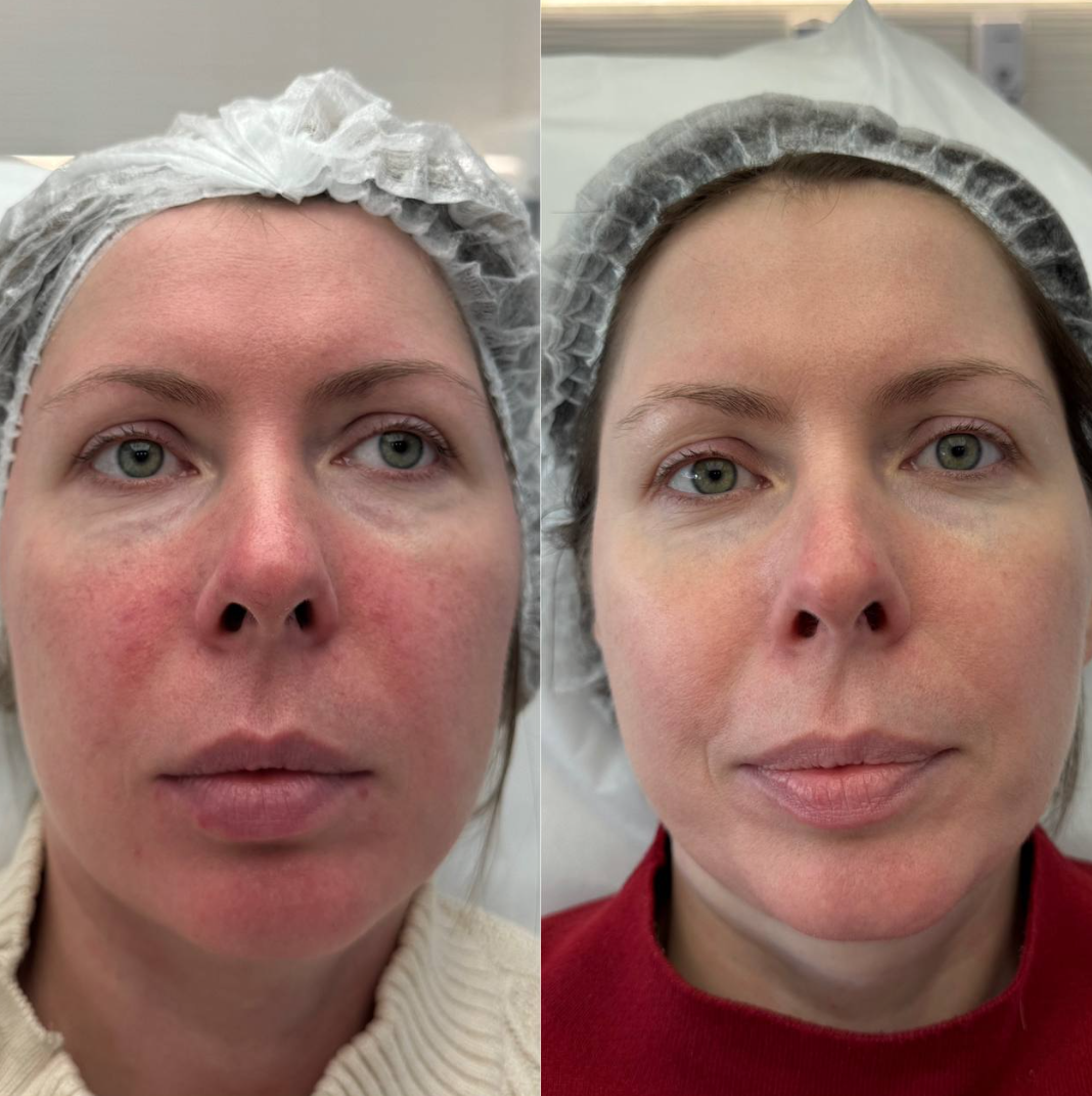 Фотодинамическая терапия Heleo4