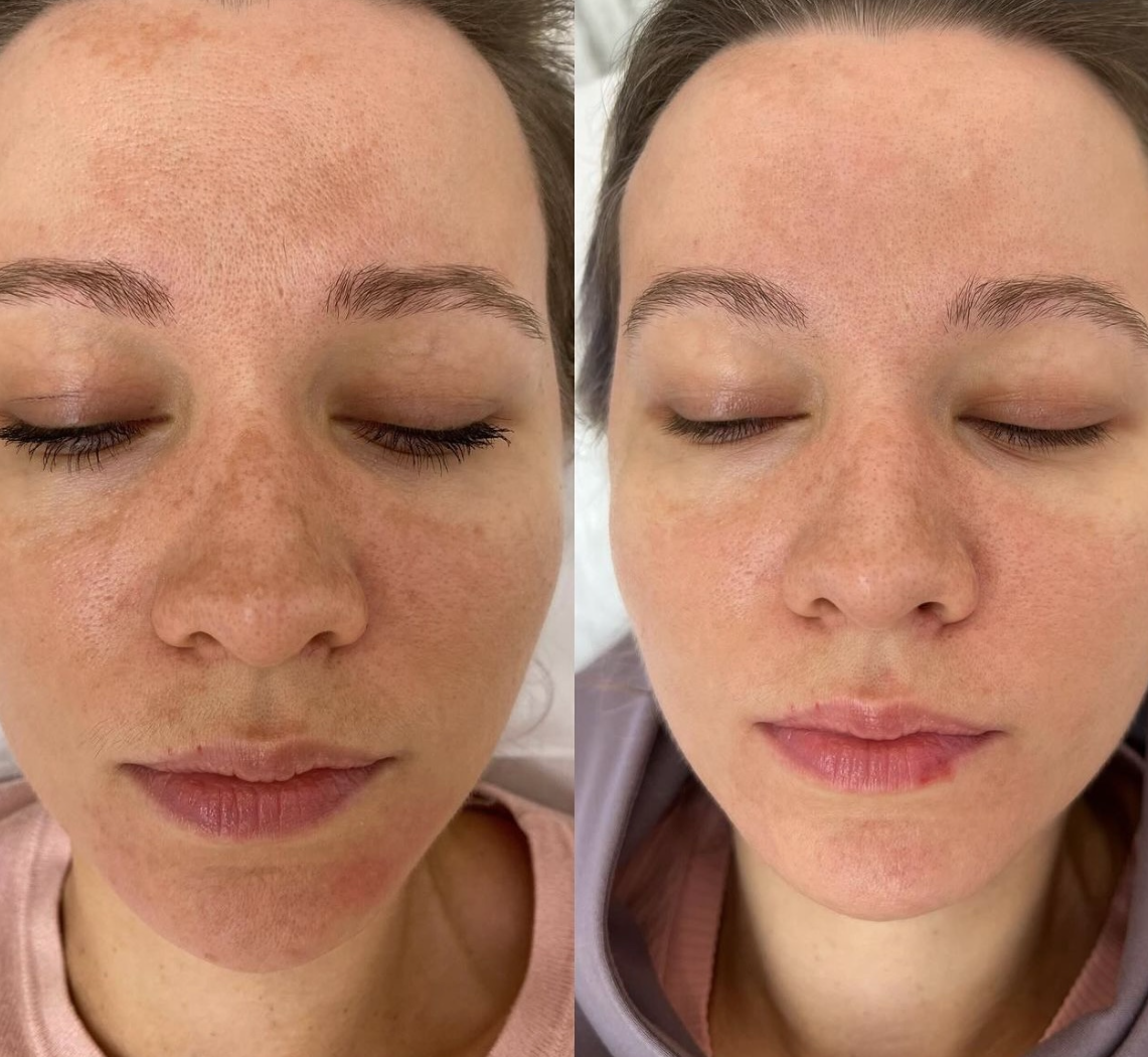 Фотодинамическая терапия Heleo4