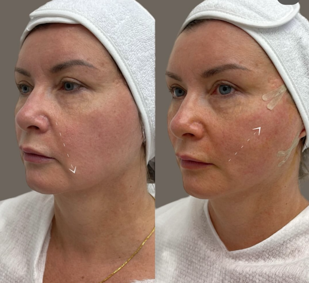 Нитевой лифтинг лица