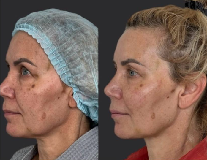 Нитевой лифтинг лица