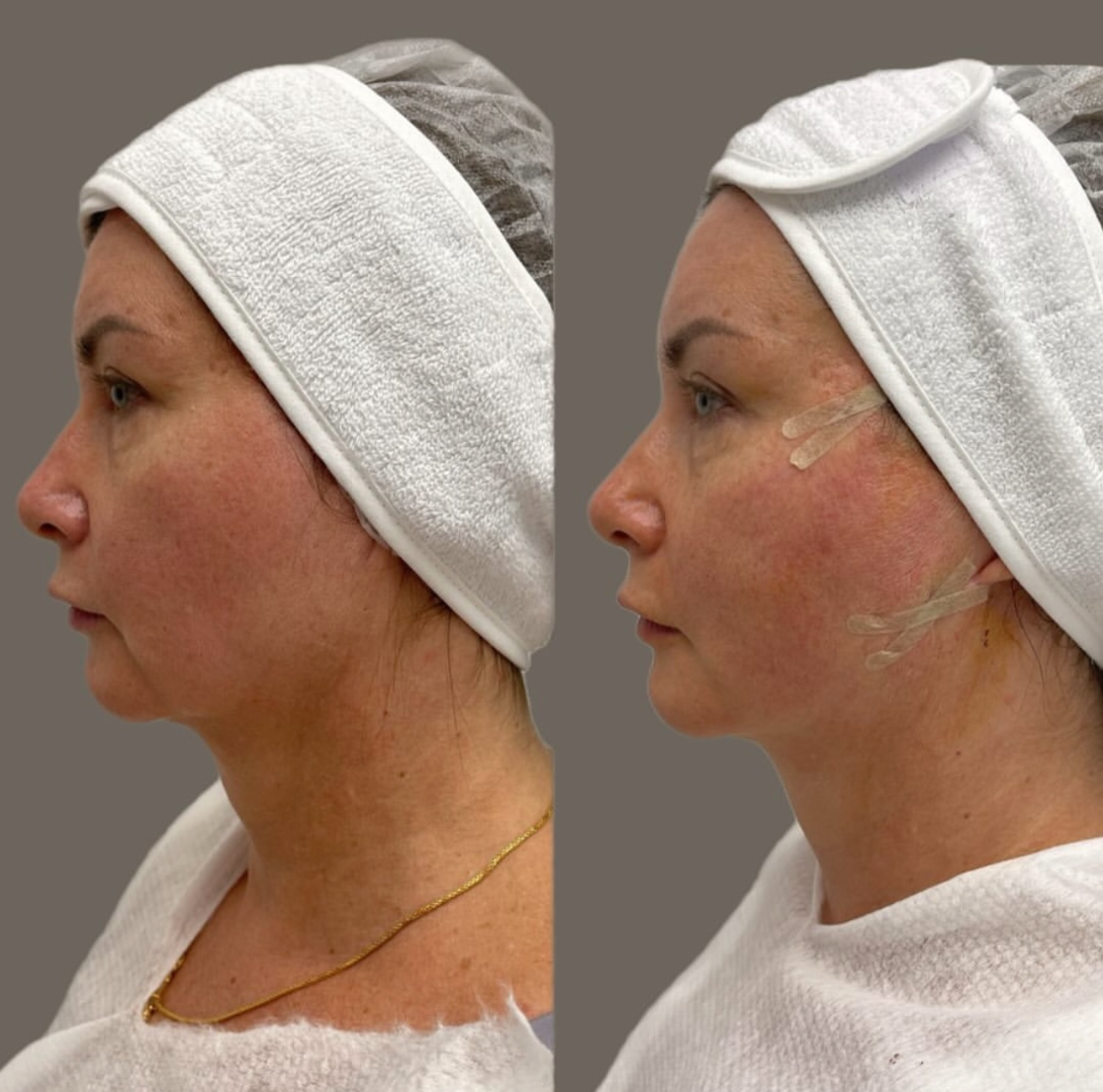 Нитевой лифтинг лица