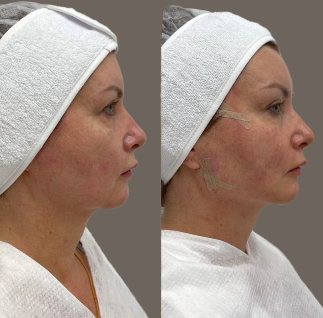 Нитевой лифтинг лица