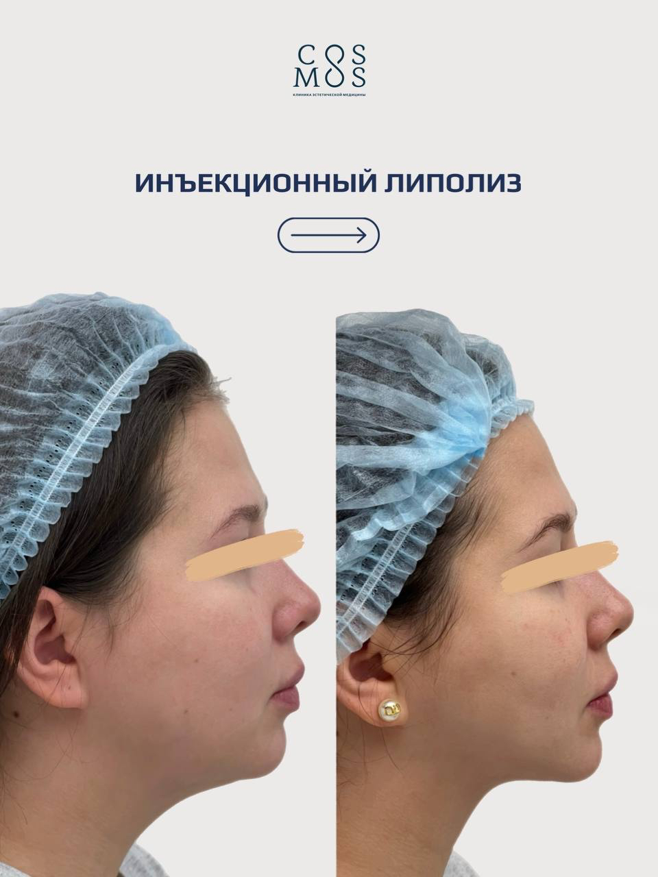 Инъекционные липолиз