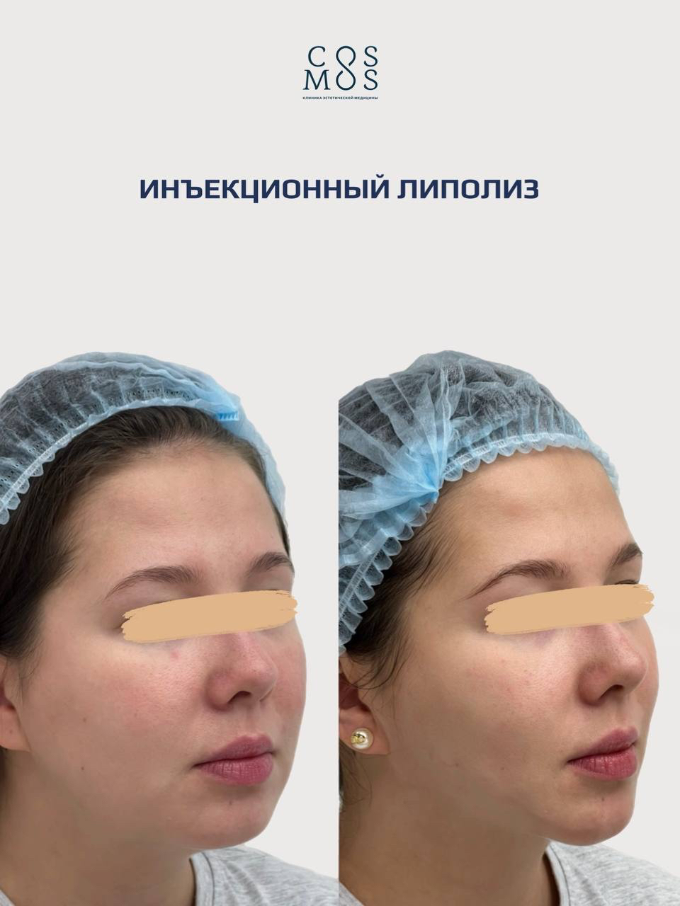 Инъекционные липолиз