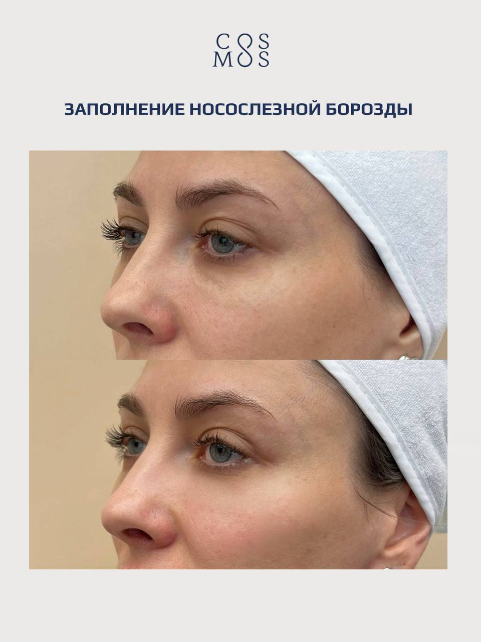 Заполнение носослезной борозды