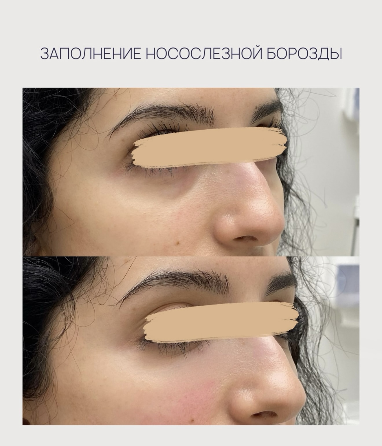 Заполнение носослезной борозды