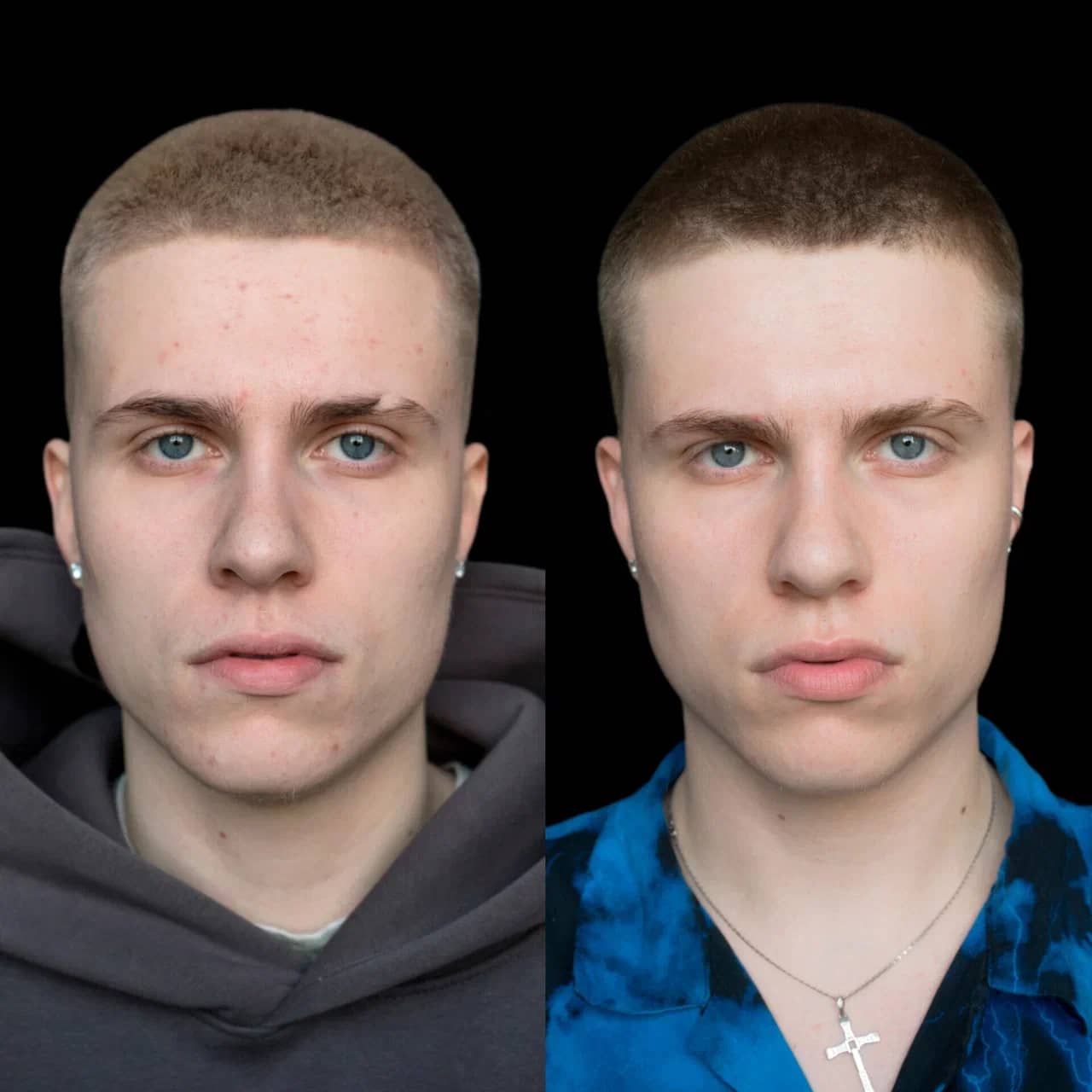 Холодная плазма PLADUO