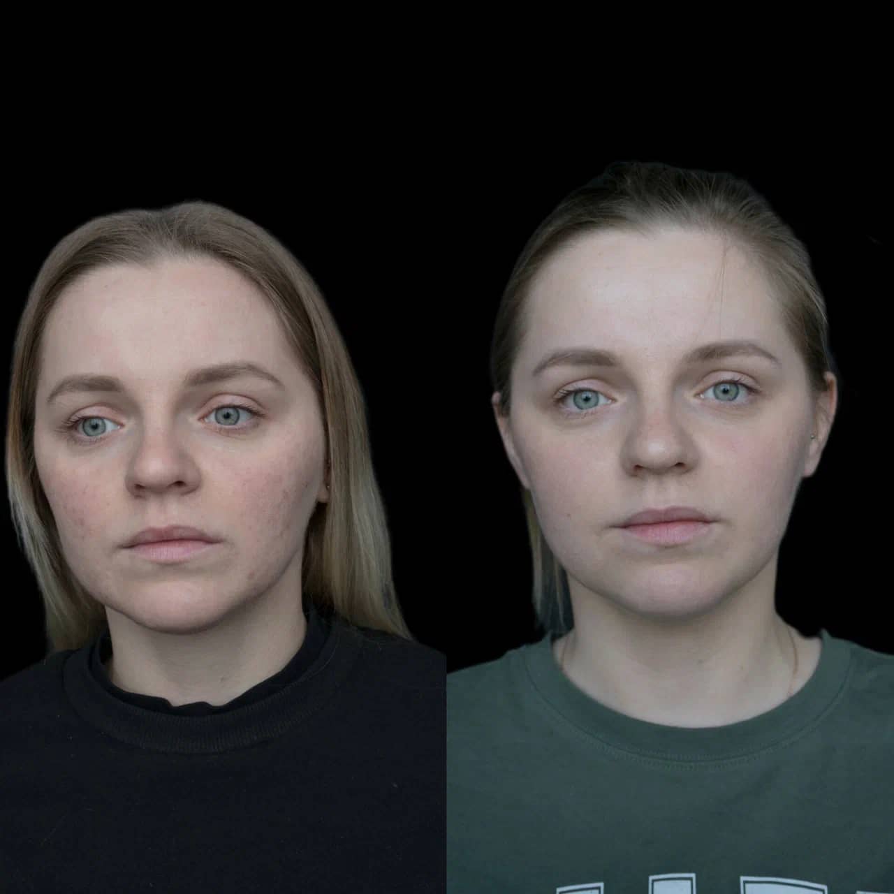 Холодная плазма PLADUO