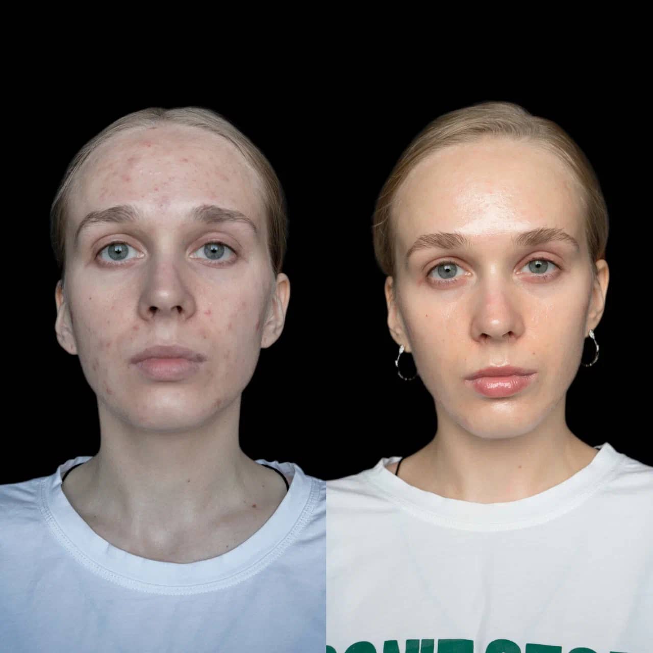 Холодная плазма PLADUO