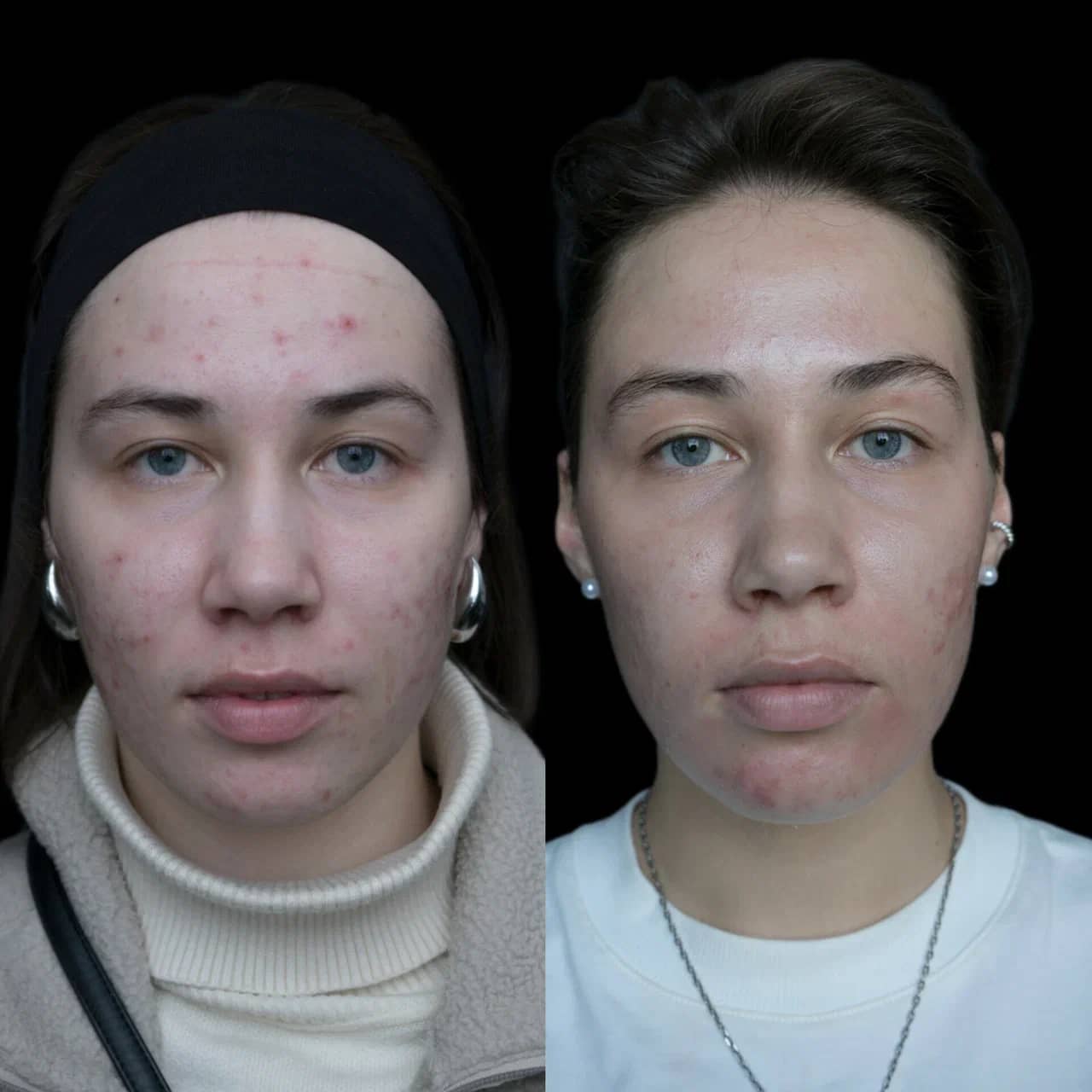 Холодная плазма PLADUO